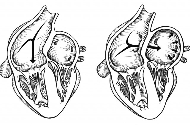 A Controversial Link Between Migraines and Patent Foramen Ovale